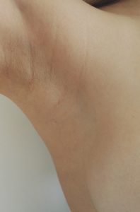 Cicatrice du creux axillaire à 1 an