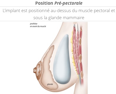 position des prothèses en pré-pectorale