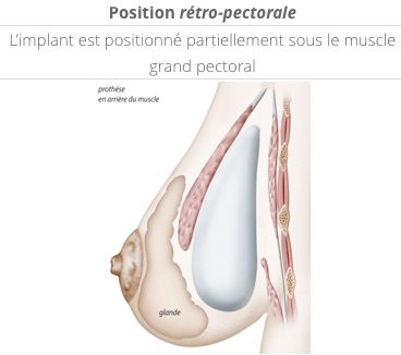 position des prothèses en rétro-pectorale